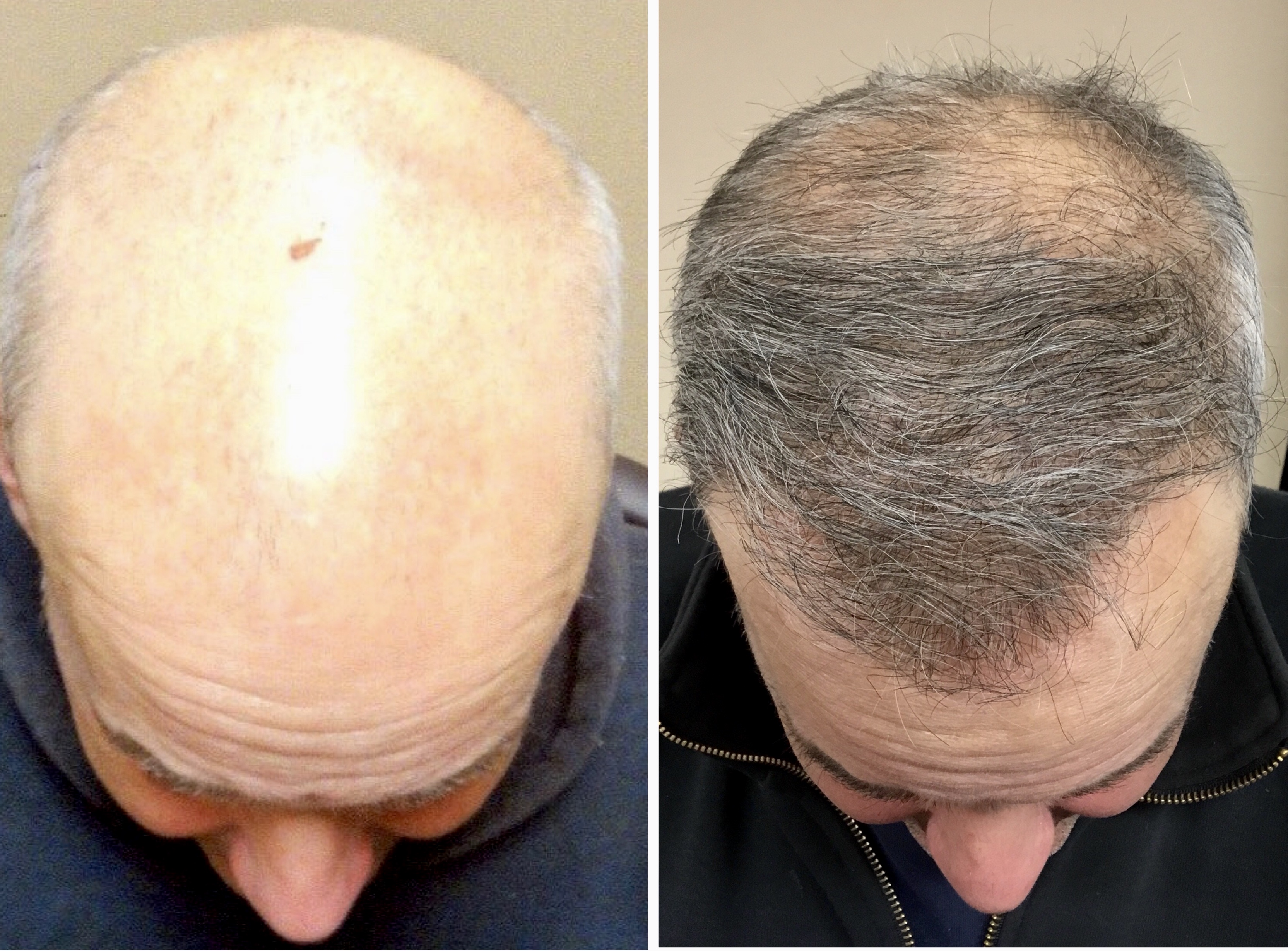 Hair Transplant Los Angeles, Eyebrow Restoration - Marc Dauer MD