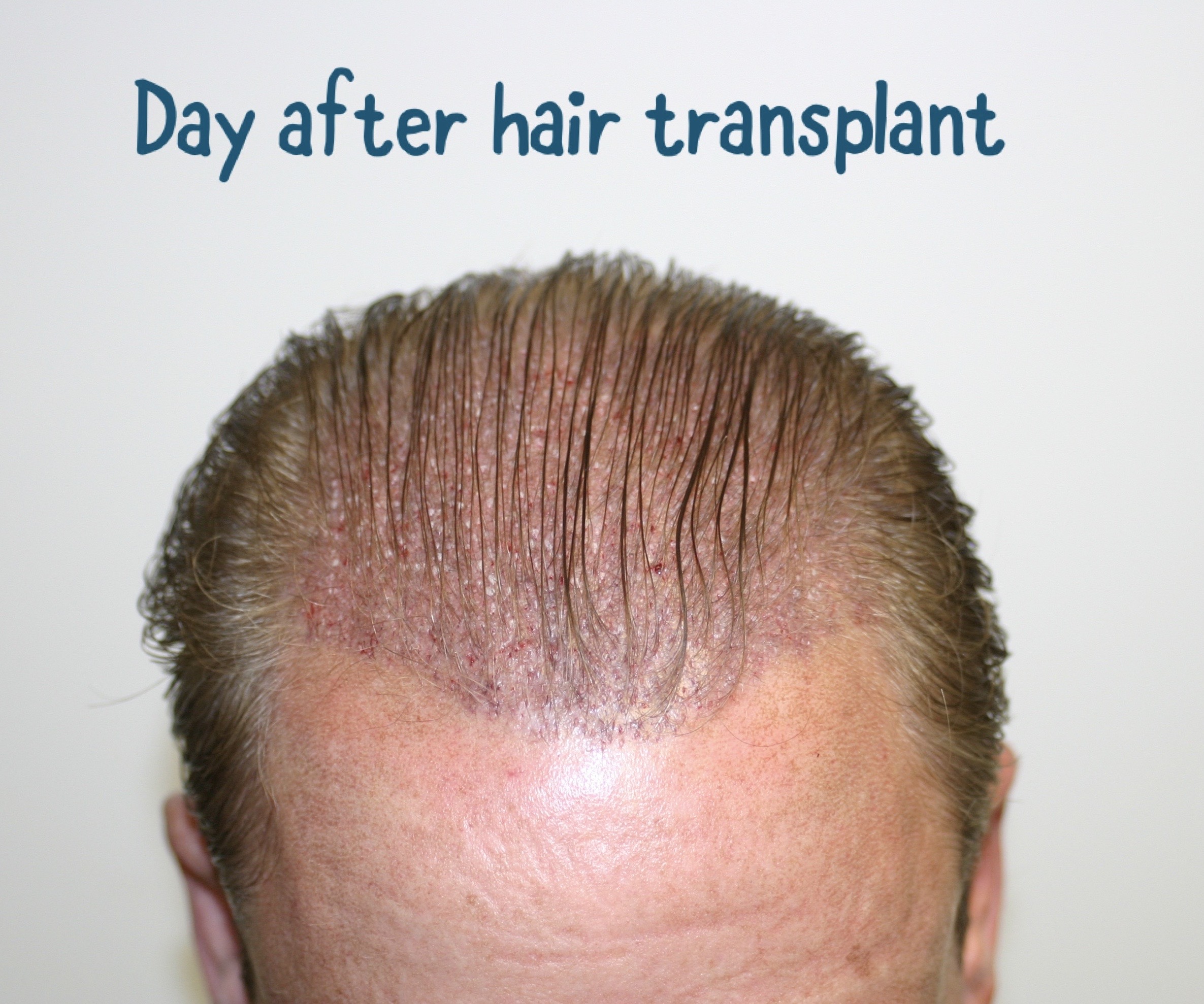 Are Female Hair Transplants on the Rise Two Women on Their Hair Loss