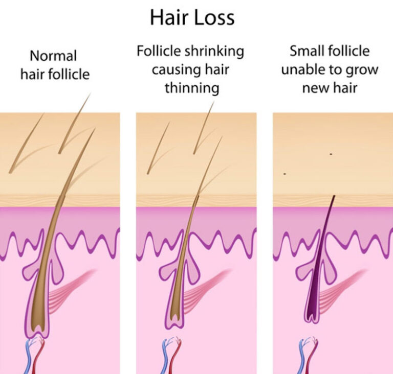 Diagnosing The Cause Of Hair Loss Boston MA New Hampshire NH